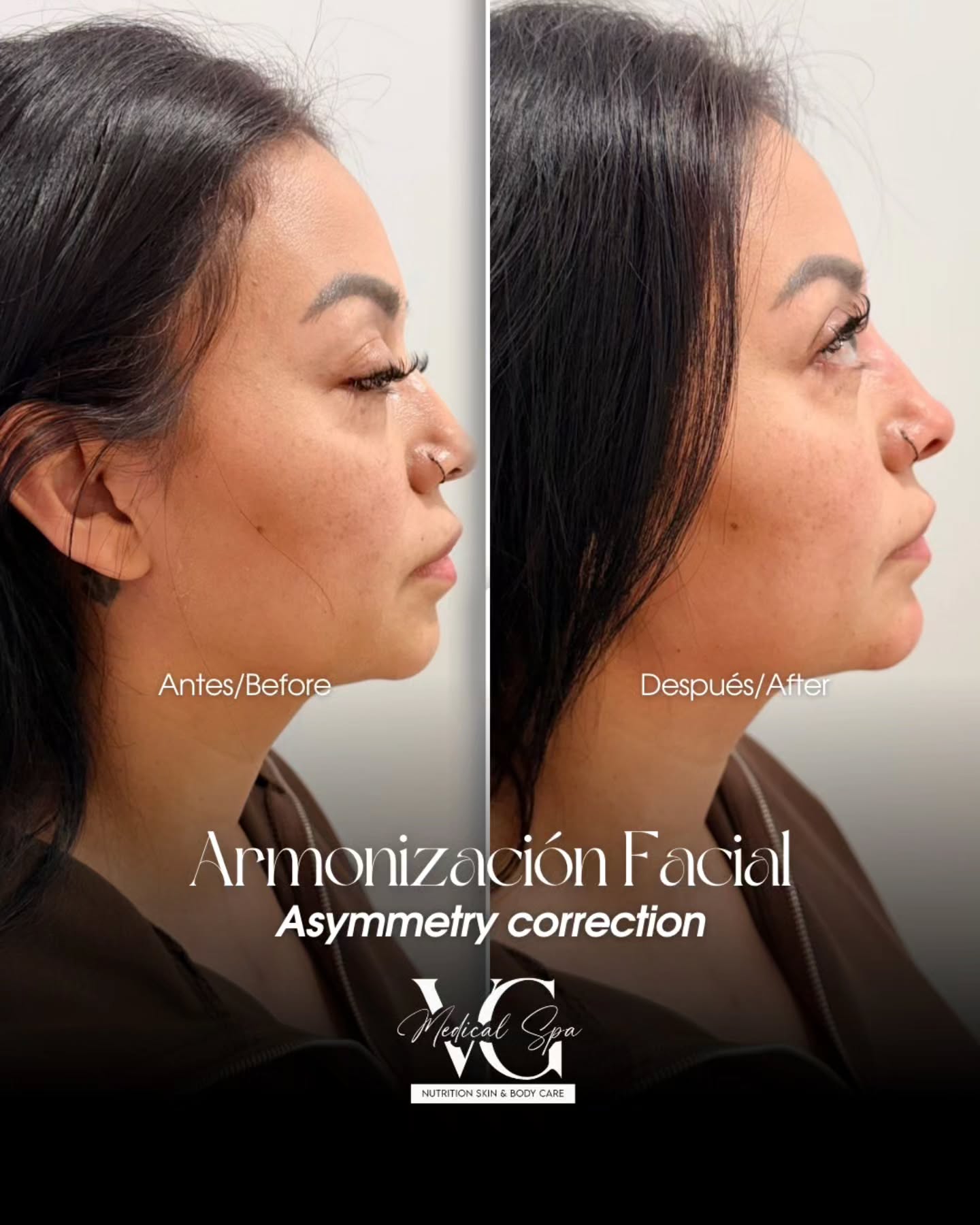 Before and after injectable treatment result