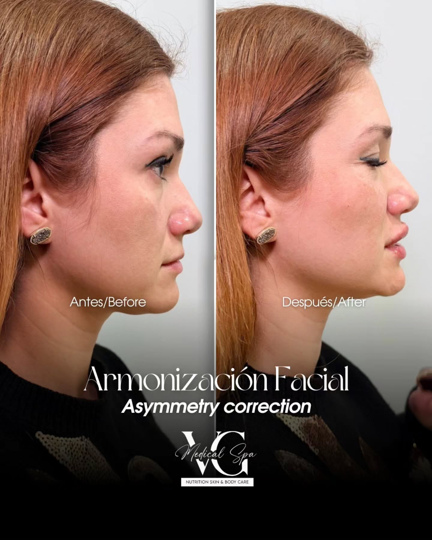 Before and after facial balancing photo result